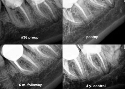 Leczenie kanałowe pod mikroskopem zęba 36, kontrola po 4 latach