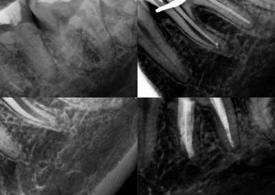 Usunięcie złamanego narzędzia i leczenie kanałowe pod mikroskopem - ząb 36