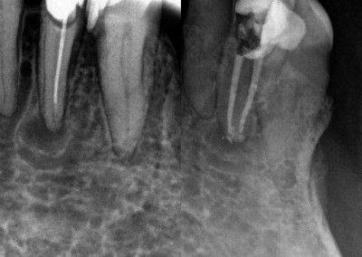 Ponowne leczenie kanałowe pod mikroskopem zęba 32
