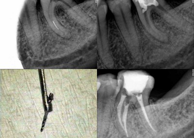 Usunięcie złamanego narzędzia i leczenie kanałowe pod mikroskopem - ząb 36