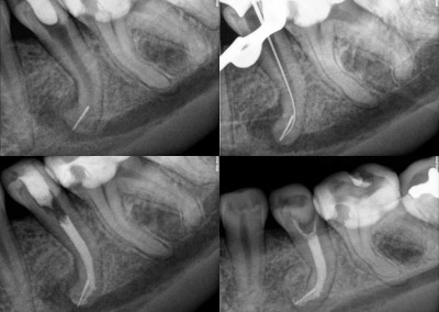 Obejście złamanego narzędzia i leczenie kanałowe pod mikroskopem zęba 35