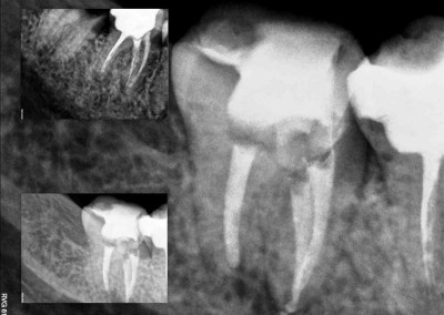 Ponowne leczenie kanałowe pod mikroskopem zęba 46