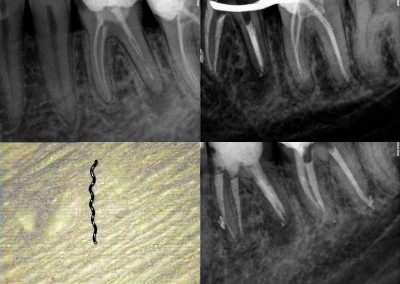Usunięcie złamanego narzędzia i reendo - zęby 36 i 37