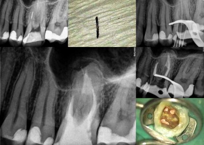 Usunięcie złamanego narzędzia i reendo - ząb 26