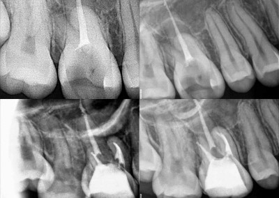 Ponowne leczenie kanałowe pod mikroskopem - ząb 16