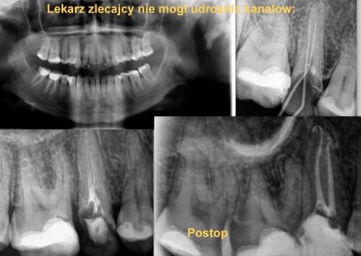 Leczenie kanałowe pod mikroskopem zęba 15