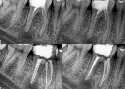 Ponowne leczenie kanałowe pod mikroskopem - ząb 46 czterokanałowy