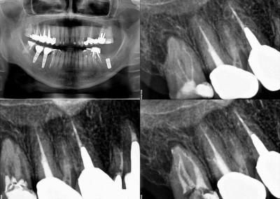 Ponowne leczenie kanałowe pod mikroskopem - ząb 17