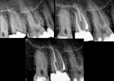 Leczenie kanałowe pod mikroskopem - ząb 17