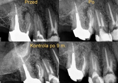 Ponowne leczenie kanałowe pod mikroskopem - zęby 16 i 15