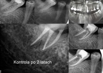 Leczenie kanałowe pod mikroskopem - ząb 47