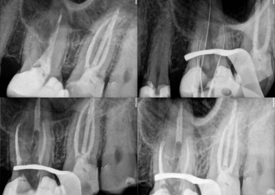 Leczenie kanałowe pod mikroskopem powtórne - ząb 26