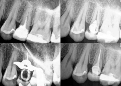 Ponowne leczenie kanałowe pod mikroskopem - ząb 25