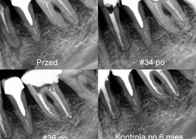 Ponowne leczenie kanałowe pod mikroskopem - zęby 34 i 36