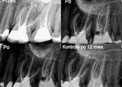 Ponowne leczenie kanałowe pod mikroskopem - ząb 27