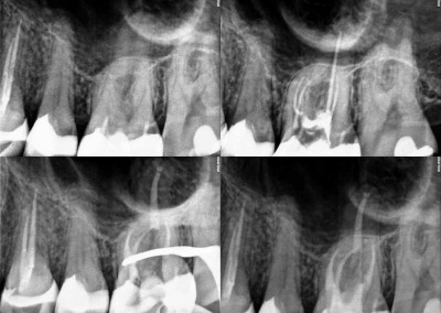 Leczenie kanałowe pod mikroskopem - ząb 26 czterokanałowy