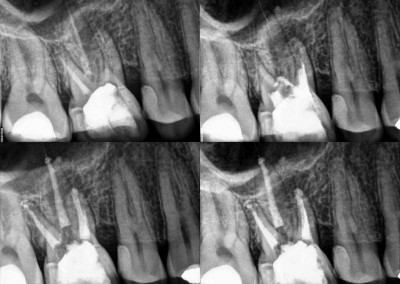 Ponowne leczenie kanałowe pod mikroskopem zęba 16