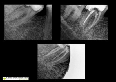 Leczenie kanałowe pod mikroskopem - ząb 47