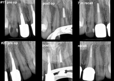 Ponowne leczenie kanałowe pod mikroskopem zębów 11 i 21