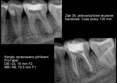 Leczenie kanałowe pod mikroskopem zęba 36