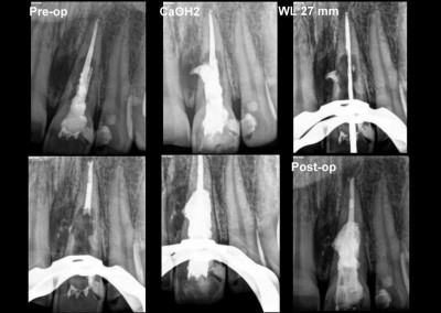 Leczenie kanałowe zęba z rozległą resorpcją wewnętrzną
