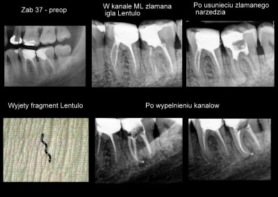 Reendo i usunięcie złamanego narzędzia - ząb 37