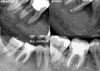 Leczenie kanałowe pod mikroskopem - ząb 46