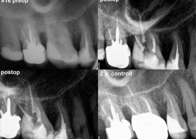 Leczenie kanałowe pod mikroskopem - ząb 16