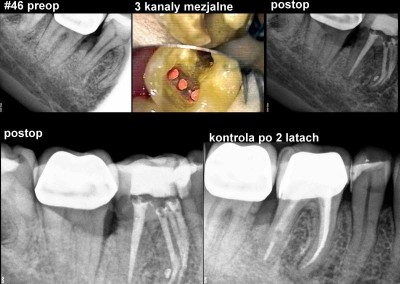 Leczenie kanałowe pod mikroskopem - ząb 46