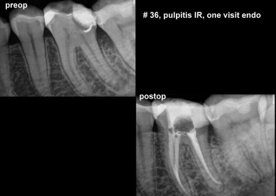 Leczenie kanałowe pod mikroskopem - ząb 36