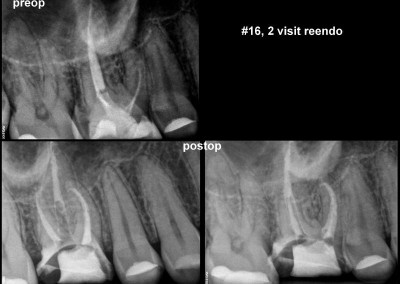 Ponowne leczenie kanałowe pod mikroskopem - ząb 16
