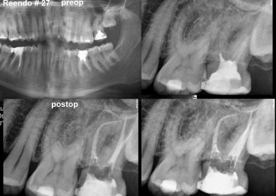 Ponowne leczenie kanałowe pod mikroskopem - ząb 27