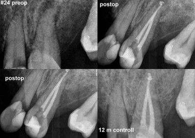 Leczenie kanałowe pod mikroskopem zęba 24