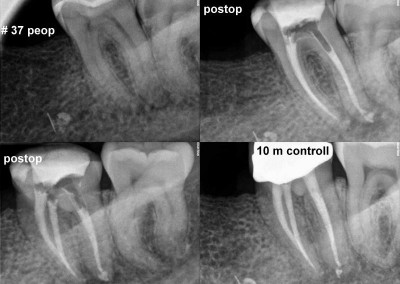 Leczenie kanałowe pod mikroskopem zęba 37