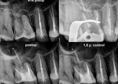 Leczenie kanałowe pod mikroskopem zęba 16