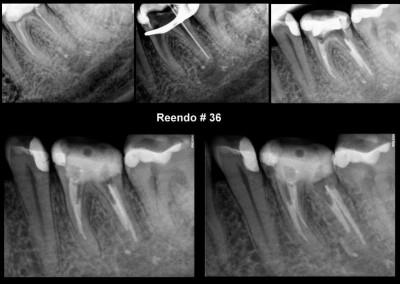 Ponowne leczenie kanałowe pod mikroskopem zęba 36