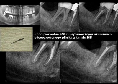 Leczenie kanałowe pod mikroskopem zęba 46