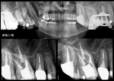 Leczenie kanałowe pod mikroskopem zębów 15 i 16