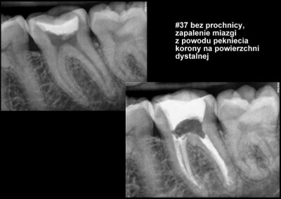 Leczenie kanałowe pod mikroskopem zęba 37