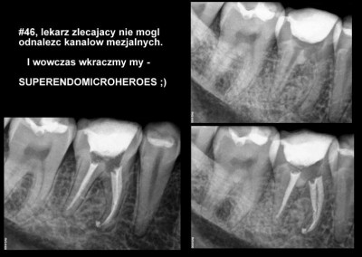 Leczenie kanałowe pod mikroskopem zęba 46