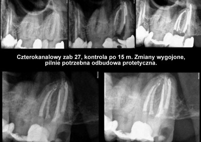 Leczenie kanałowe pod mikroskopem zęba 27