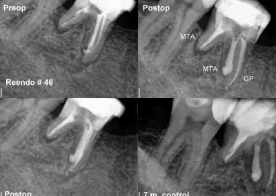 Ponowne leczenie kanałowe pod mikroskopem zęba 46
