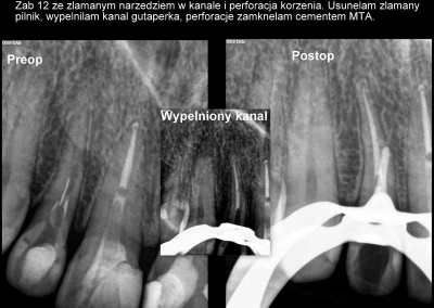 Usunięcie złamanego narzędzia i zamknięcie perforacji w zębie 12