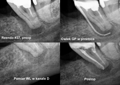 Powtórne leczenie kanałowe pod mikroskopem zęba 37 z przetoką