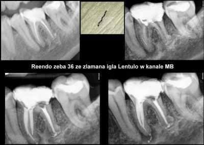 Ponowne leczenie kanałowe pod mikroskopem i usunięcie złamanego narzędzia - ząb 36