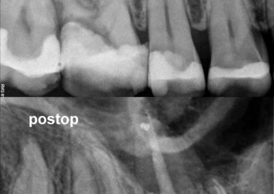 Leczenie kanałowe pod mikroskopem zęba 16