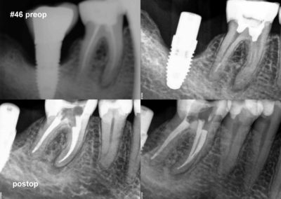 Leczenie kanałowe pod mikroskopem zęba 46