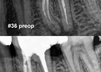 Leczenie kanałowe pod mikroskopem zęba 36