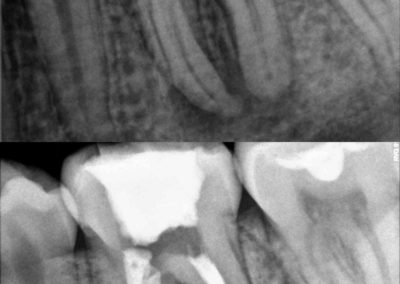 Leczenie kanałowe pod mikroskopem zęba 37