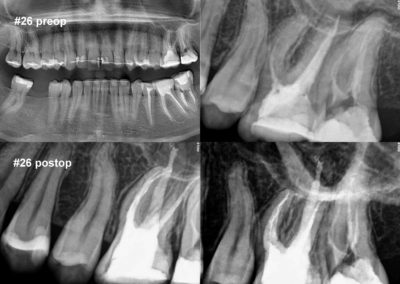 Powtórne leczenie kanałowe pod mikroskopem zęba 26